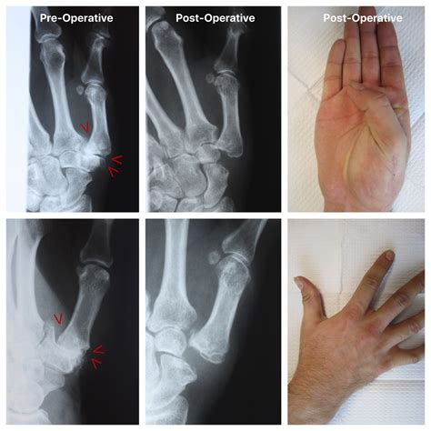 Thumb Arthritis Treatment In Raleigh By Dr Erickson