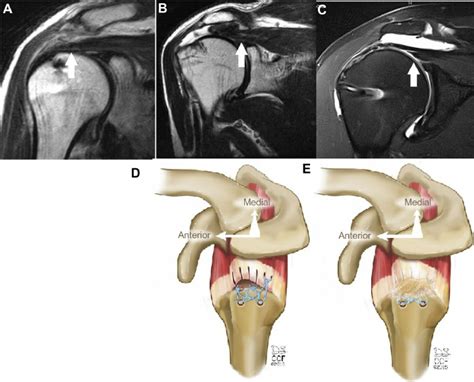 Modes Of Rotator Cuff Failure Notes A Intact Repair On MRI Note