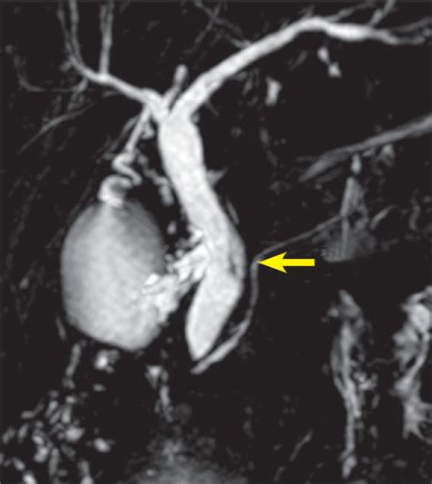 Mrcp Image Shows Mild Dilation Of The Common Bile Duct And Linear