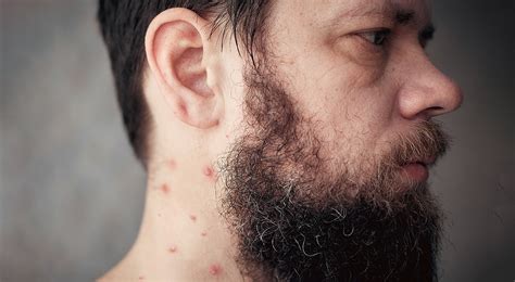 Pimple On Neck Causes And How To Treat Them Healthnews