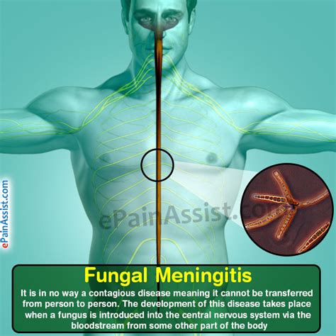 Fungal Meningitisrisk Factorssignssymptomsdiagnosistreatment