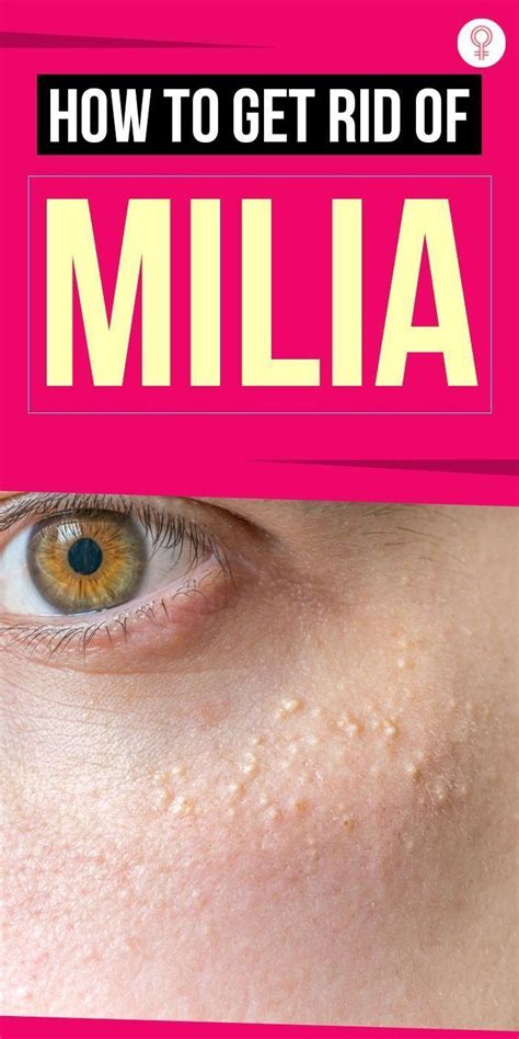 How To Get Rid Of Milia At Home Prevention Tips Artofit