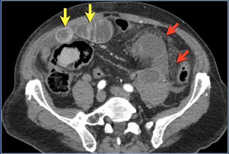 What Is A Ct Scan With Contrast Like