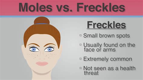Difference Between Freckles And Moles