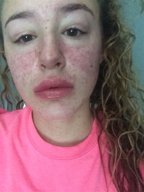 Day 1 Of Amoxicillin Allergic Reaction Allergic Reaction Amoxicillin