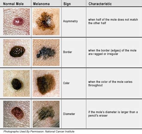 How To Tell If A Mole Is Cancerous Or Not