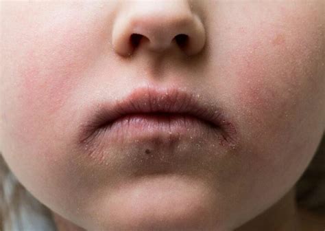 Understanding The Causes Of Impetigo In Children And Adults