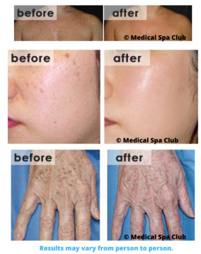 Pigment Spots Medical Spa Club