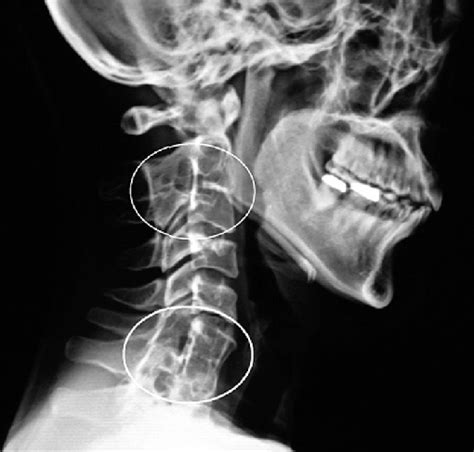 Radiograph Of The Cervical Spine Lateral View Download Scientific