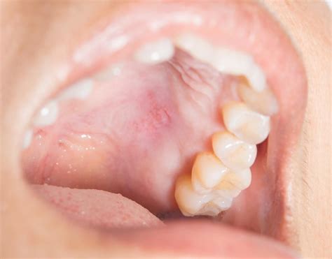 what causes a bump on the roof of the mouth roof of mouth sore canker sore mouth ulcers