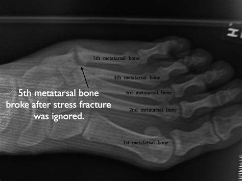 Stress fracture foot problems commonly affect athletes and runners. Can I run with a stress fracture in my foot? - DOC