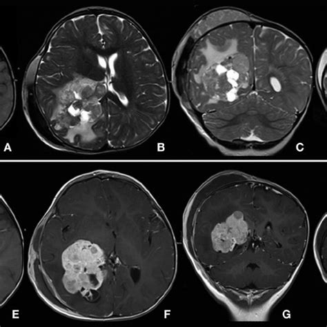 Choroid Plexus Carcinoma Of Right Ventricle In 2 Year Old Girl With