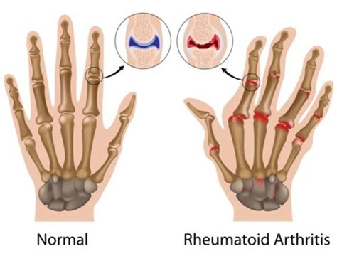 Rheumatoid Arthritis Medlineplus Genetics