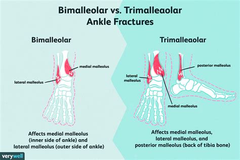 Bimalleolar And Trimalleolar Ankle Fractures