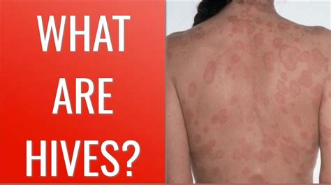 Allergic Reaction Symptoms Of Hives