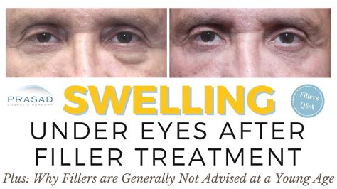 Possible Causes And Treatment Of Swelling Under The Eyes With Cosmetic Fillers Youtube