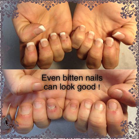 Bitten Nails Can Look Equally As Good As Natural Nails They Just Need