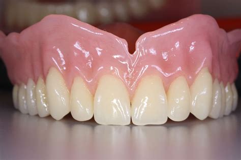 How To Take Care Of Your Immediate Dentures Inhome Dentures