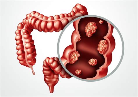 Types Symptoms And Screening Of Intestine Cancer Mhospital