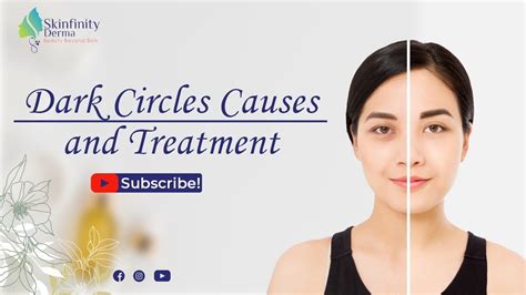 Dark Circle Treatment Dark Circles Causes And Treatment Dark
