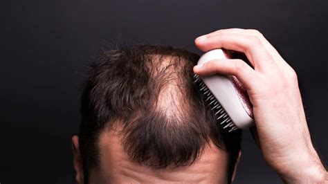 La chute de cheveux normale. Perte de cheveux - Quelles solutions s'offrent à vous