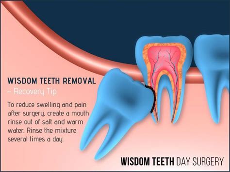 Most oral surgery patients experience some bleeding and swelling in the first 24 to 48 hours after a tooth extraction. High-pitched Sensitive Teeth After Filling # ...
