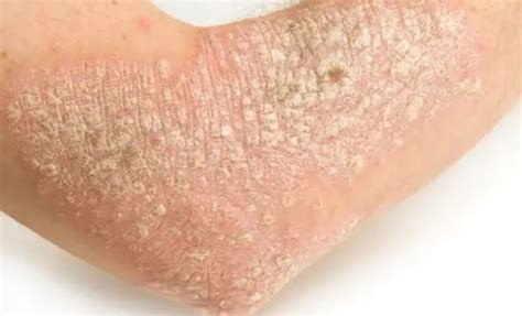 Dry Scaly Skin Patches On Elbows