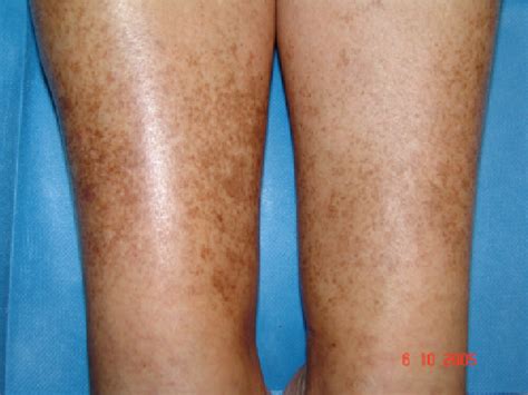 Figure 1 From Pigmentation Due To Stasis Dermatitis Treated