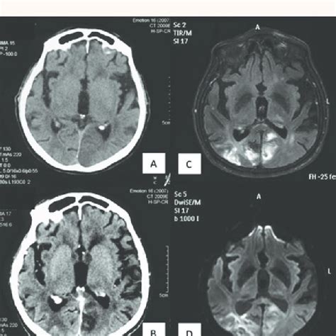 Pdf Bilateral Cortical Blindness Due To Bilateral Occipital Infarcts