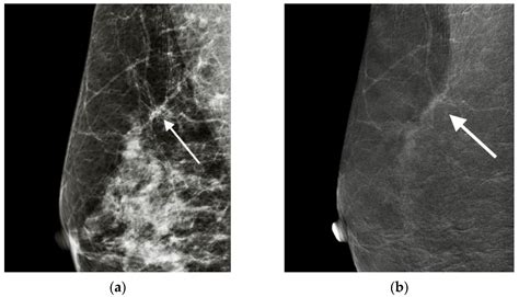 Cancers Free Full Text Contrast Enhanced Mammographic Features Of In Situ And Invasive