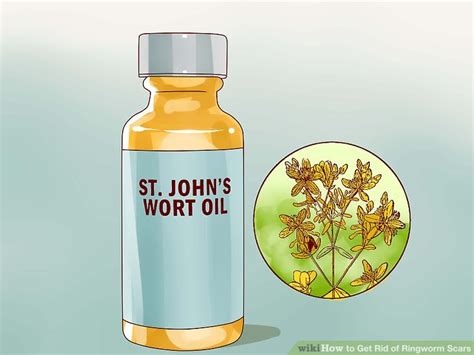 Ringworm causes come from a group of organisms known as dermatophytes. 3 Ways to Get Rid of Ringworm Scars - wikiHow