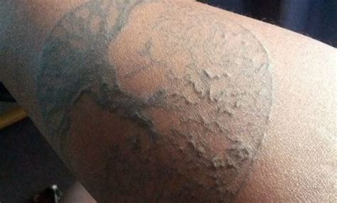 Bumpy Rash On Arm After Tattoo • Arm Tattoo Sites