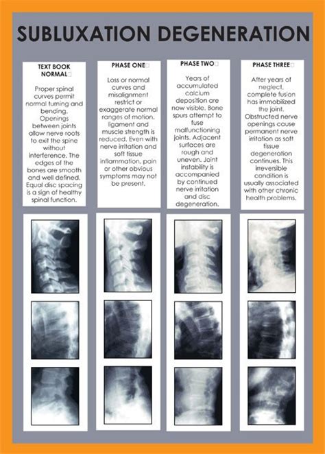 Spinal Degeneration Faulkner Chiropractic And Wellness