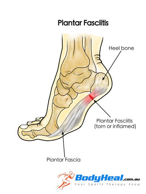 What Is Plantar Fasciitis Causes Symptoms Treatment Options BodyHeal