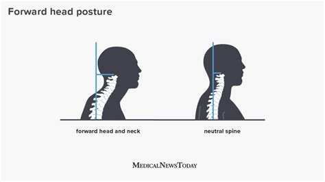 Forward Head Posture Definition Cause And How To Treat It 2022