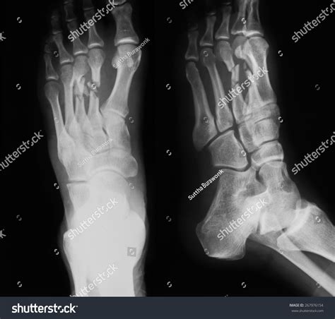 X Ray Image Of Foot Ap And Oblique View Show Fracture Of The Second
