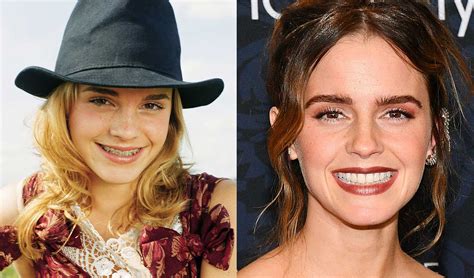 Celebrities With Braces Before And After Famous Brace Faces