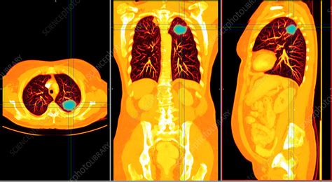 Lung Cancer Ct Scan Stock Image C0123828 Science Photo Library