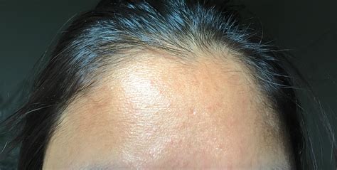 Routine Help Shiny And Dehydrated Lines On Forehead Oily Nose