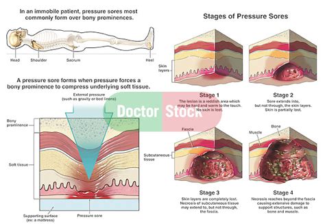 Formation Of A Pressure Sore Doctor Stock