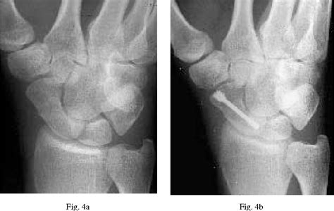 Figure From Herbert Screw Fixation Of Scaphoid Fractures Semantic Scholar