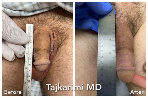 Penile Implant PENUMA Specialist Top Northern VA Urologist