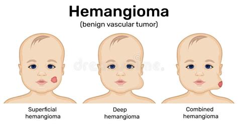 Illustration Of Infantile Hemangioma Stock Vector Illustration Of