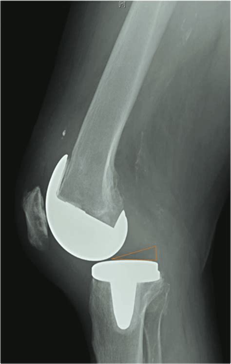 Lateral Knee Radiograph At Presentation To Our Clinic Revealing