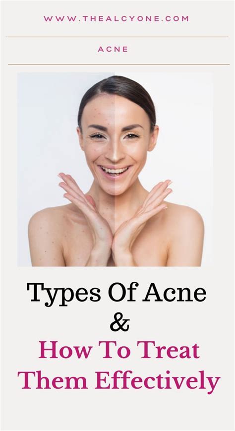 Different Types Of Acne And How To Treat Them Artofit