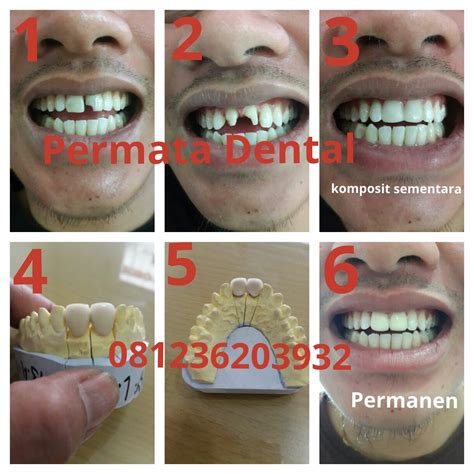 DOKTER GIGI BALI PERMATA DENTAL : Porcelain crowns | Gigi crown | Gigi