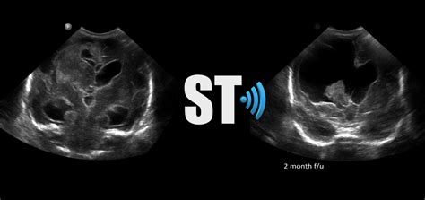 Intraventricular Hemorrhage Sonographic Tendencies