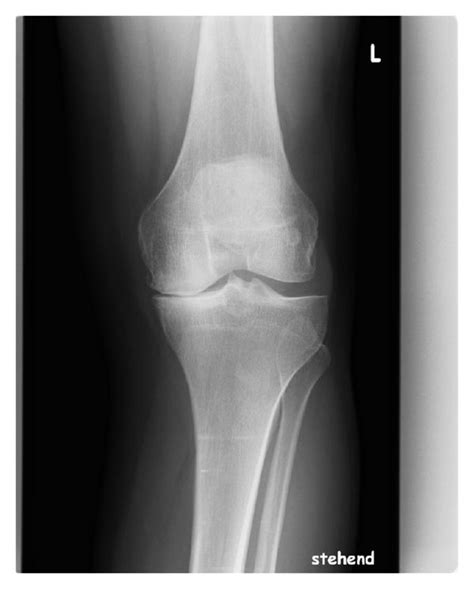Parameters covered in the above test : X-ray of a Columbus knee: a.p. view pre- and ...