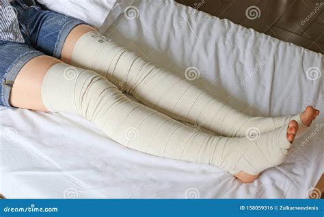 Postoperative Elastic Bandage On The Legs Of A Girl Stock Photo Image Of Hospital Accident
