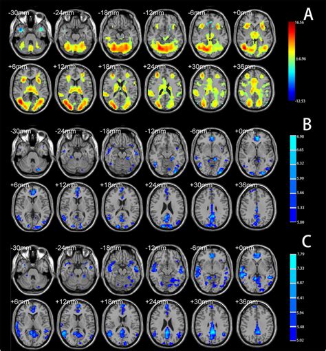 A Brain Regions Showing Significant Activation Under The Montreal